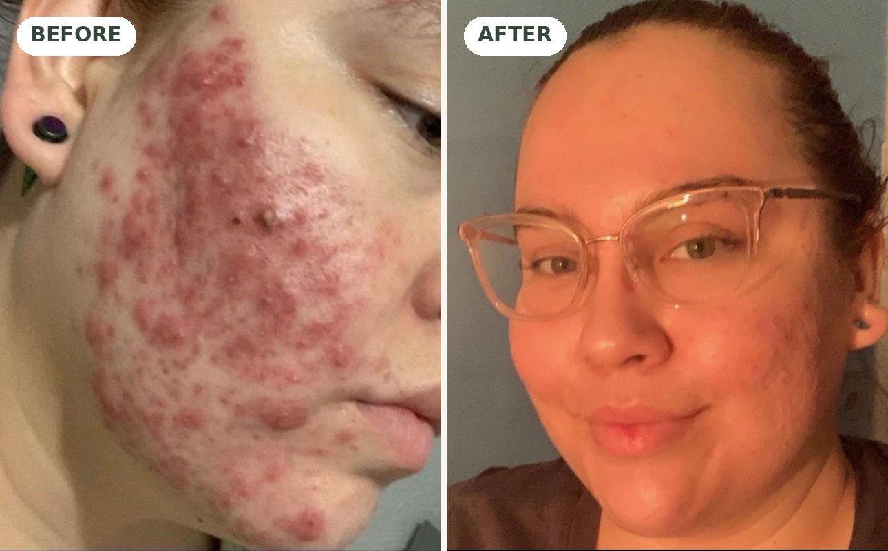 Grade 4 acne before and after