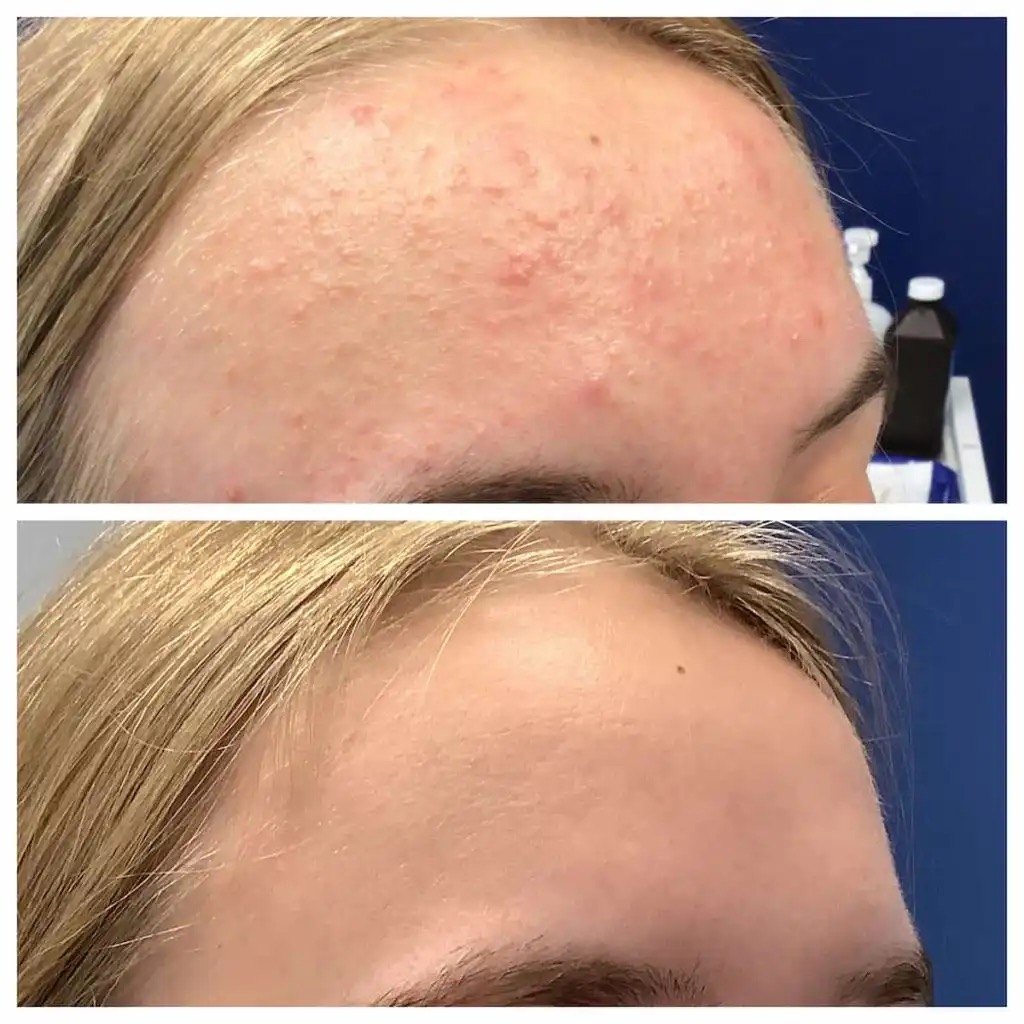 Grade 1 acne before and after