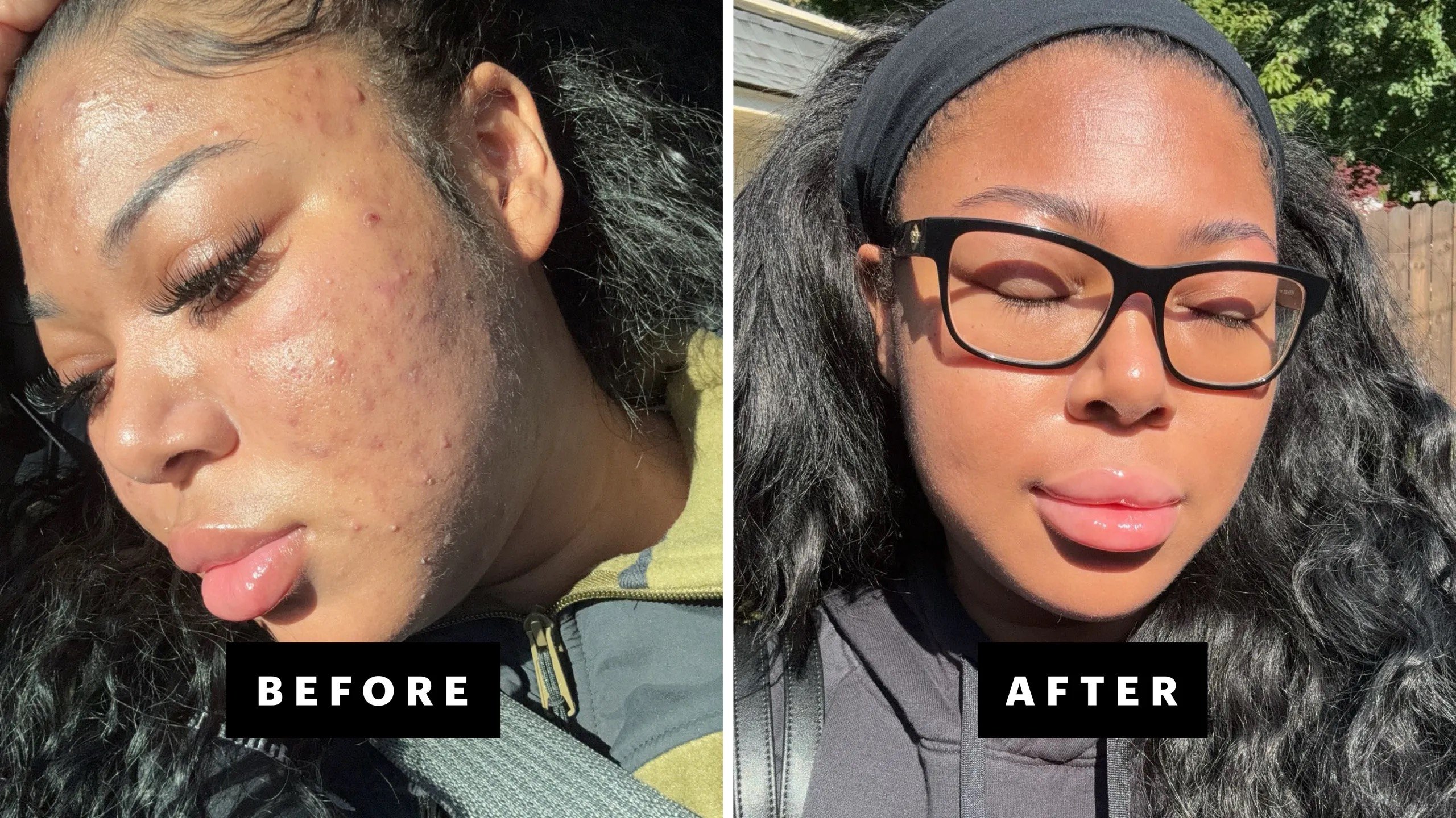 Grade 2 acne before and after