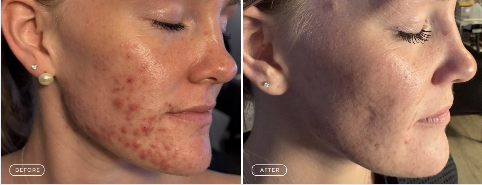 Grade 3 acne before and after
