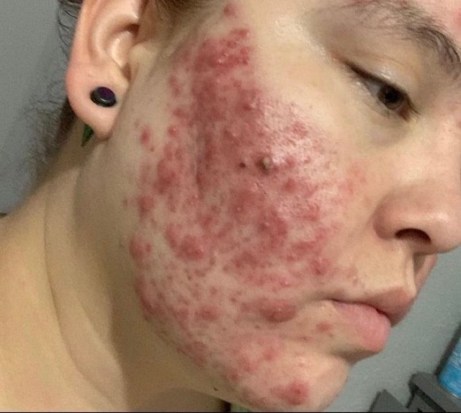 Grade 4 acne before