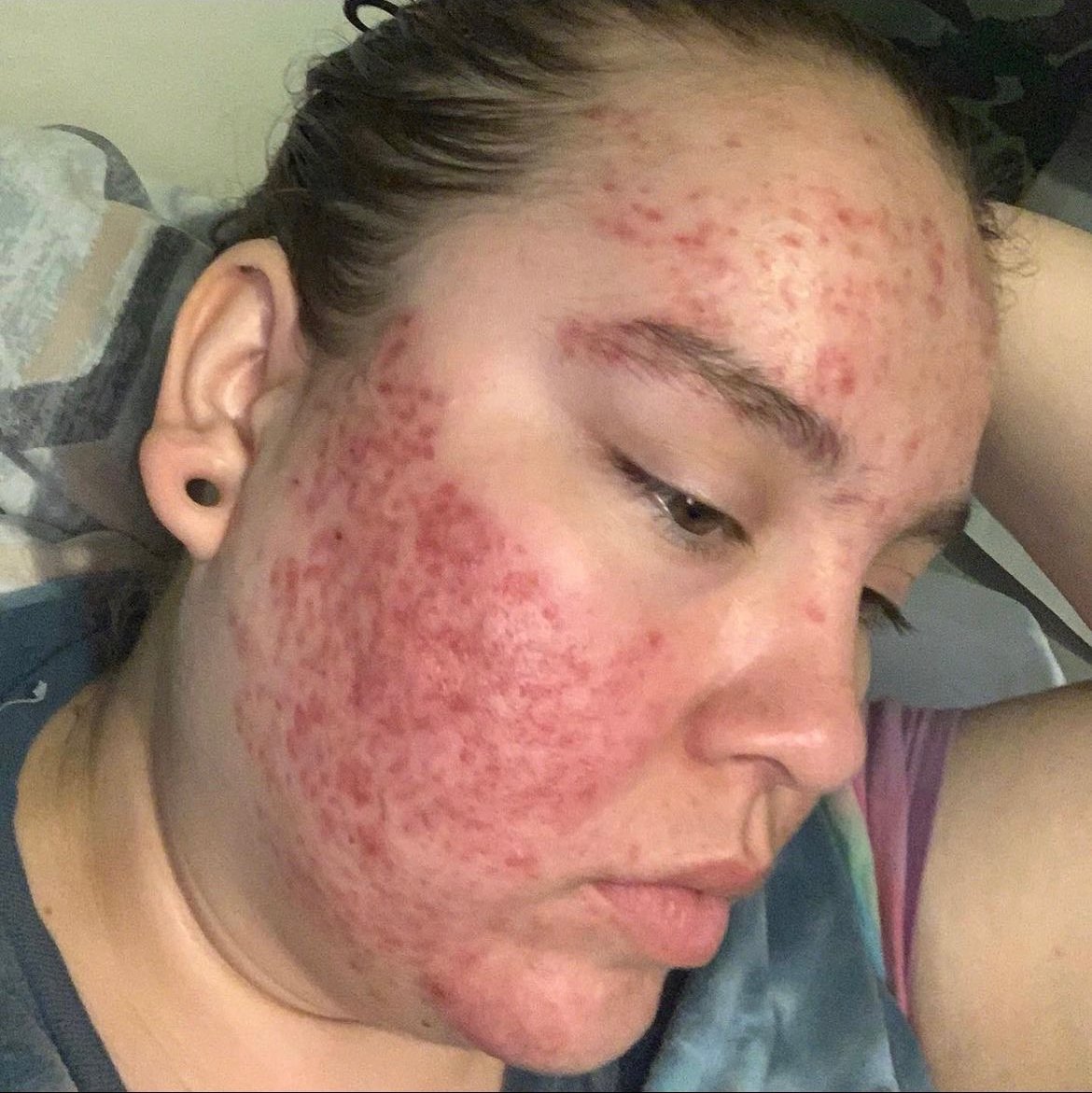 Acne progress